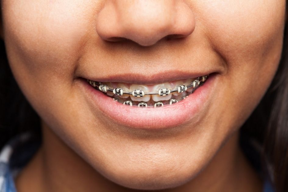 cost of front 4 teeth braces in india